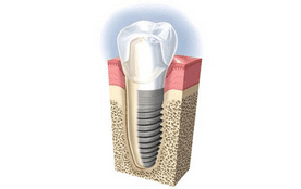 CEOP - Centro de Especialidades Odontológicas Premium implante